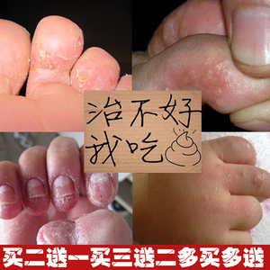 治疗脚气灰指甲儿童脚癣水泡型脱皮止痒杀菌药膏哺乳期裂口溃烂脚