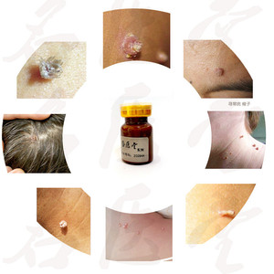 005人付款淘宝去除脖子颈部丝状肉猴皮赘尤点身上腋下