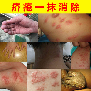 疥疮膏疥灵霜特效止痒林旦硫磺软膏疥霜结节皮肤一扫光干疥疮灵药