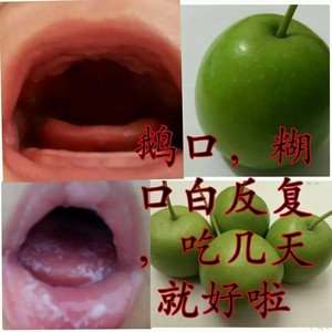 鹅口 反复性 雪口 婴幼儿 糊口白 广西上梨 超多好评