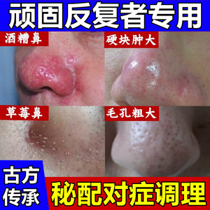 治酒糟鼻红鼻子专用药修复草莓鼻红血丝去黑头祛粉刺除螨痤疮软膏