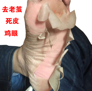 脚后跟硬皮