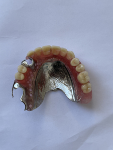 老年人活动假牙维修,断裂,断芽粘接修补!顺便免