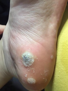 跖疣鸡眼脚垫膏贴涂抹后去除脱落掉舒适无痛苦手部足部全新正品