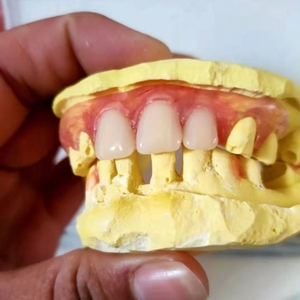 生产活动义齿隐形义齿假牙定制缺牙齿假牙套缺少牙齿 下单前请