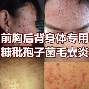 【头皮马拉色菌】头皮马拉色菌品牌,价格 - 阿里巴巴