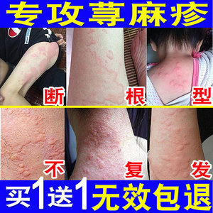 荨麻疹过敏止痒断根专用药膏治疗急性慢性风团划痕皮肤瘙痒克星寻