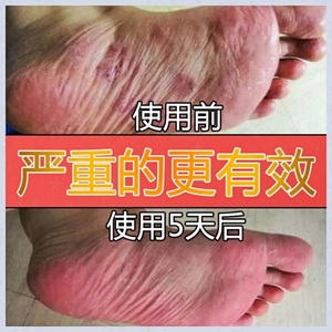 花乐安官网花乐喷剂四季止痒足康抑菌安正品花乐水泡止痒膏旗舰店