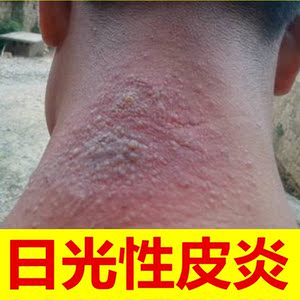 日光性皮炎去外用除药膏根的紫外线过敏神经性脂溢性李一氏治治疗