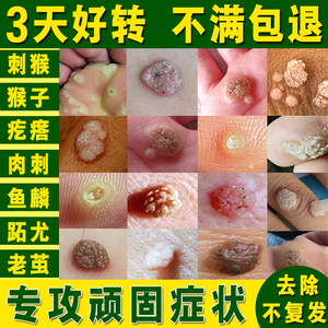 祛肉刺猴专用药去猴子肉粒疙瘩治脚手上休子鱼鳞痣点瘊子去除神器