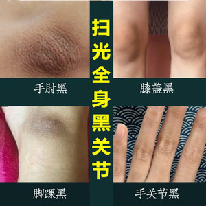 去除黑色素膝盖