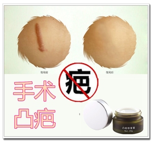 700人付款淘宝烫伤淡化去除黑印色素沉淀疤痕增生凸起疙瘩软化抑疤灵