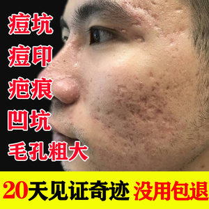 去痘坑凹洞修复男痘疤