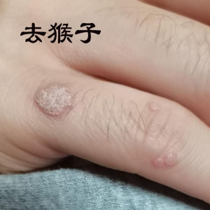 五氟尿嘧啶软膏