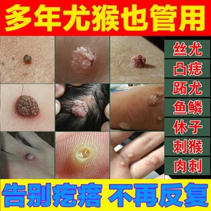 氟尿嘧啶软膏正品5-五疣必治官方旗舰店趾疣去根疣瘊肉粒一抹无忧