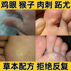 去鸡眼扁平疣去除膏脚上长肉刺去猴子肉粒疙瘩专用药正品点疣药膏