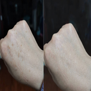 【2021手斑克星】女除手老年黑班祛斑男去除手背斑点黑点的药护肤