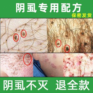 云南本草百部酊虱立净灭阴虱药男女私处一扫光治去除头虱子药喷剂
