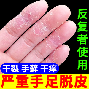 手足脱皮修复膏脚痒干燥手痒季节性手干裂起泡严重起皮破裂抑菌膏