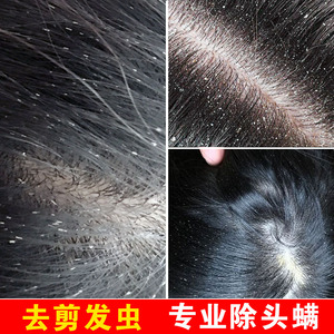 去卷发虫专业除吃发虫儿童去屑止痒断发抗真菌除螨虫剪发虫洗发水