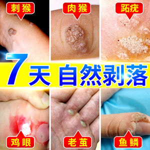 祛刺猴去除正品修子药去猴子肉粒疙瘩手足部脚肉刺去除膏鱼鳞痣贴