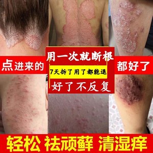 癣药膏外用皮肤