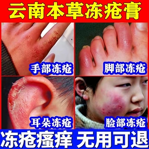 云南白药冻伤膏