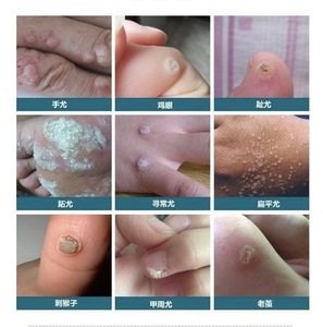 疣瘊净丝状去除颈部脖子上长的小肉粒疙瘩肉刺皮赘鸦胆子软膏肉痣