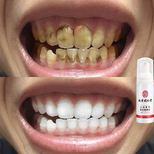南京同仁堂洁牙慕斯洁白牙齿清新口气口臭去除黄牙黑垢牙结石烟渍
