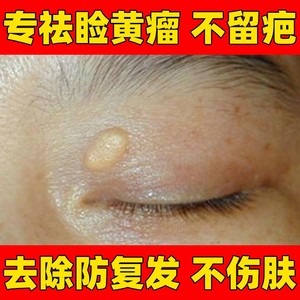 00北凡百货店淘宝治疗睑黄疣圆眼部去除睑黄瘤的特效药膏眼皮脸祛