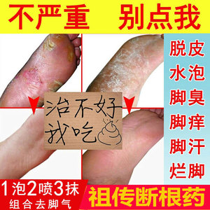 治疗香港脚特效药膏止痒脱皮杀菌根治脚气去脚臭出汗真菌泡脚药包