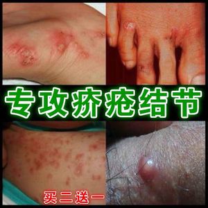 600人付款淘宝疥疮药膏疥疮结节特效药阴囊瘙痒止痒药膏蛋蛋痒湿疹