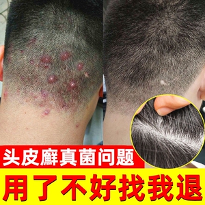 头皮真菌感染药膏