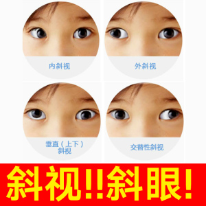 纠正斜眼对治疗眼斗鸡眼矫正器治内外斜视弱视斜视儿童训练非眼镜