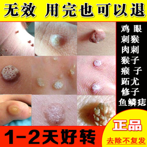 刺猴去除正品鱼鳞痣贴修子的药瘊子祛除神器手上长肉粒疙瘩跖疣膏