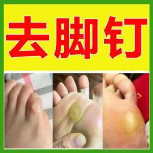 脚钉祛除膏去脚底根厚脚垫胼胝贴硬死皮软化剂脚丁老茧子专用神器