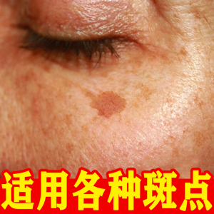 00tb25805755淘宝美白祛斑霜神器男士去斑祛斑祛老年斑去黄褐斑雀斑