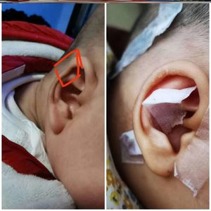 宝宝耳朵定型矫正贴婴儿招风耳轮新生儿耳部纠正婴幼儿固定型儿童