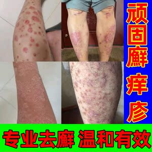 牛皮癣喷剂治牛皮鲜藓银屑牛皮癣特效药手部真菌感染老偏方药膏擦
