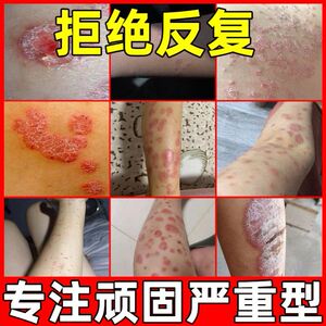 小慕晴v淘宝汗斑癣专用药鹅掌风药膏云南本草鲜手上起小水泡神农