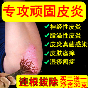 治疗脂溢性神经性面部皮炎净日光性皮肤过敏止瘙痒去根除外用药膏