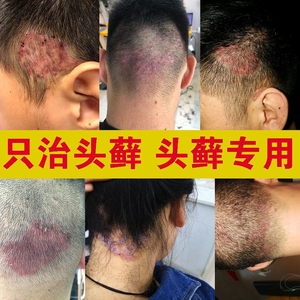 001人付款天猫特一 灰黄霉素片100片癣病体癣头癣药足癣脚藓水疱真菌