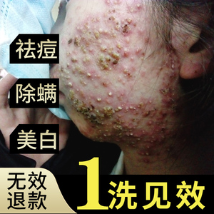 除螨虫洗面奶女