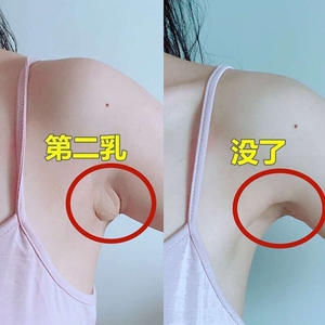 副乳正常照片腋下图片