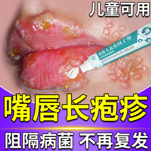 嘴巴上火起泡烂嘴角药膏嘴唇长疱疹单纯疱疹克星药儿童成人特效lg