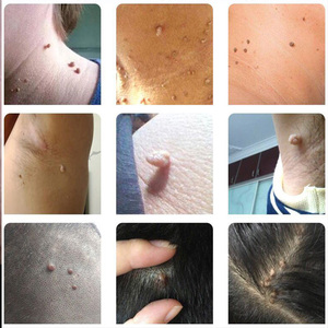 【瘊疣平软膏】瘊疣平软膏品牌,价格 - 阿里巴巴