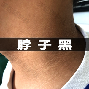 色素沉着去除颈部黑棘皮脖子黑洗不干净色产后腋下屁股美白祛关节