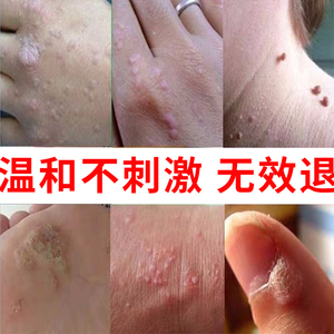 日本克疣液丝状疣立净脖子颈部头部瘊子去除克优净扁平疣肉粒疙瘩