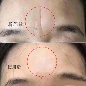 【佳琪推荐 买2送1】告另抬头纹川字纹 额头纹贴抗初老 抗皱额贴