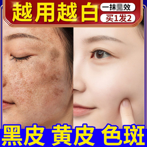 熊果苷乳膏退黑色素变白霜沉着皮秒后辅助修复复方sod熊果甙